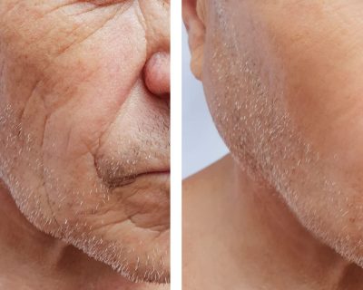 INDUCTORES DE COLAGENO